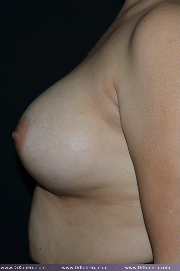 Breast Augmentation Before & After Patient #473