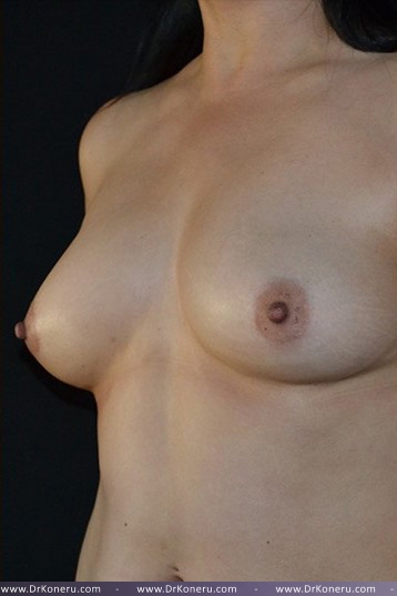 Breast Augmentation Before & After Patient #473