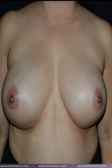 Breast Augmentation Before & After Patient #473