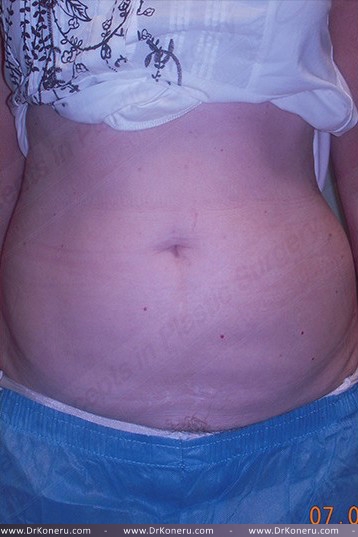 CoolSculpting Before & After Patient #739