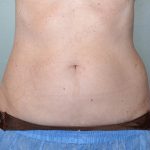 CoolSculpting Before & After Patient #739