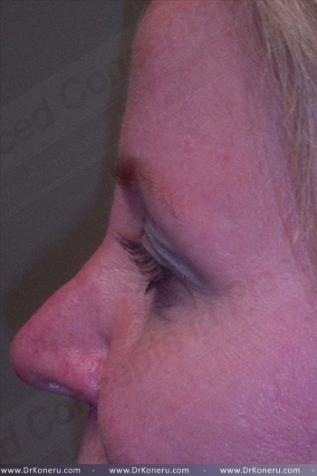 Blepharoplasty Before & After Patient #361