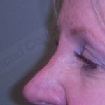 Blepharoplasty Before & After Patient #361