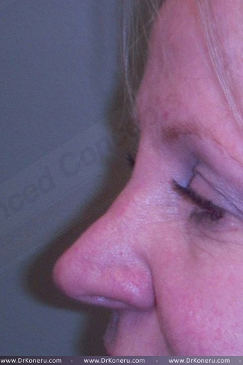 Blepharoplasty Before & After Patient #361