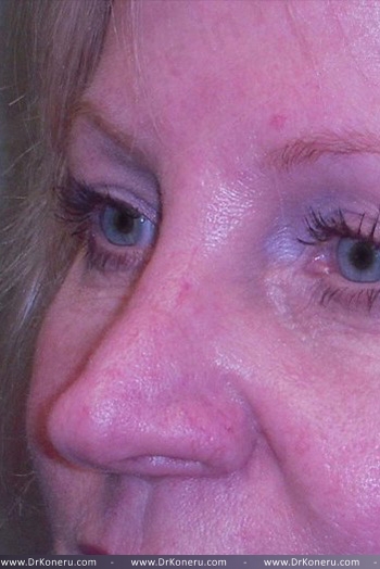 Blepharoplasty Before & After Patient #361