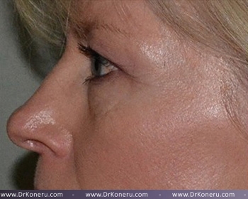 Blepharoplasty Before & After Patient #372