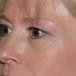 Blepharoplasty Before & After Patient #372