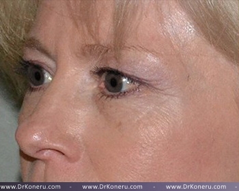 Blepharoplasty Before & After Patient #372