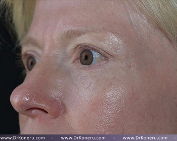 Blepharoplasty Before & After Patient #372