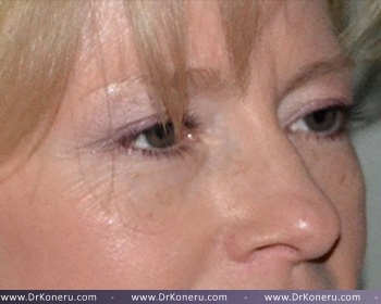 Blepharoplasty Before & After Patient #372