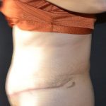 Tummy Tuck Before & After Patient #583