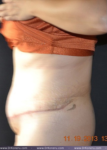 Tummy Tuck Before & After Patient #583