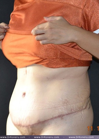 Tummy Tuck Before & After Patient #583