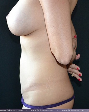 Tummy Tuck Before & After Patient #606