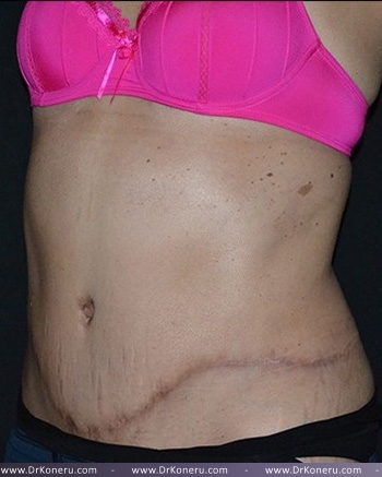 Tummy Tuck Before & After Patient #617