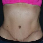 Tummy Tuck Before & After Patient #617