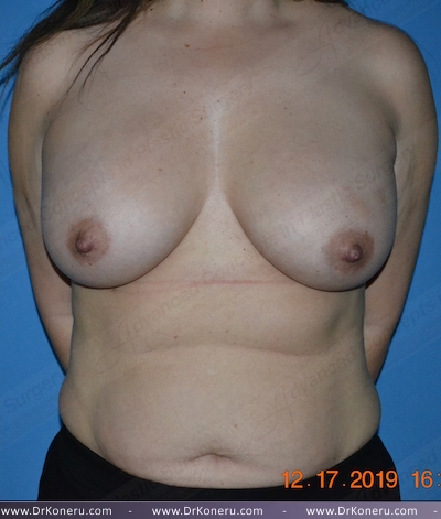 Breast Augmentation Before & After Patient #1003