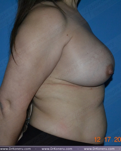 Breast Augmentation Before & After Patient #1003