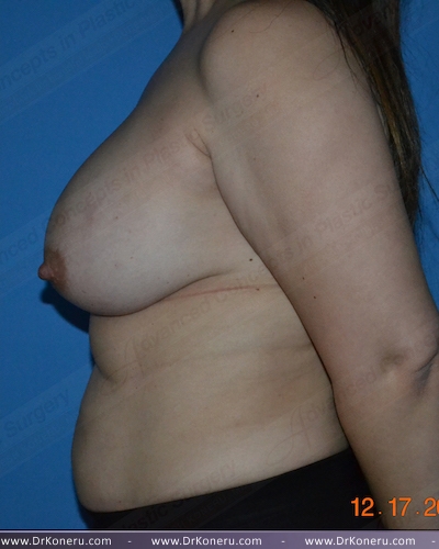 Breast Augmentation Before & After Patient #1003