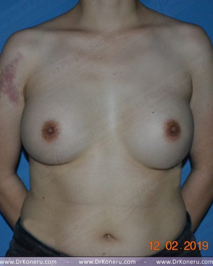 Breast Augmentation Before & After Patient #1175