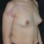 Breast Augmentation Before & After Patient #1175