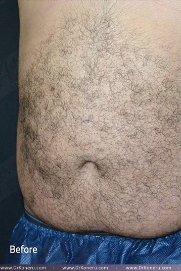 CoolSculpting Before & After Patient #1085