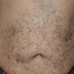 CoolSculpting Before & After Patient #1085