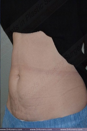 CoolSculpting Before & After Patient #1096