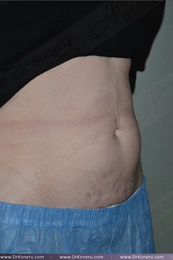 CoolSculpting Before & After Patient #1096