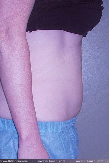 CoolSculpting Before & After Patient #1107