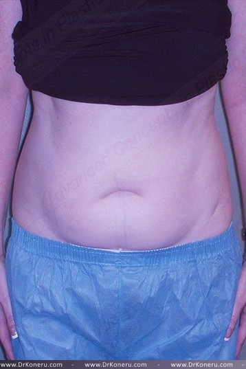 CoolSculpting Before & After Patient #1107