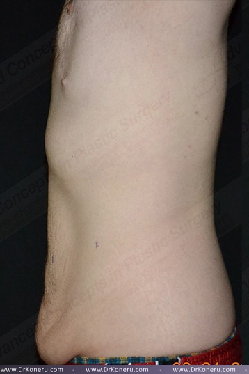 CoolSculpting Before & After Patient #1120