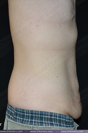 CoolSculpting Before & After Patient #1120