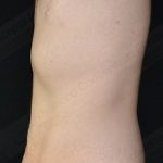 CoolSculpting Before & After Patient #1120