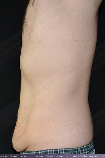 CoolSculpting Before & After Patient #1120