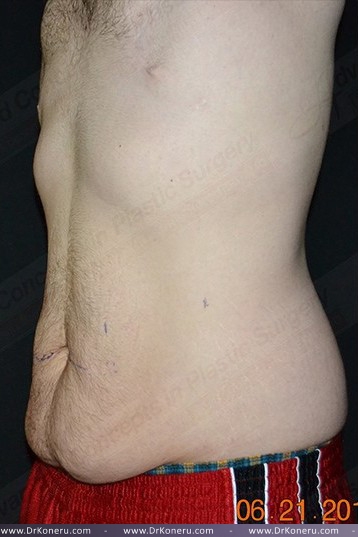 CoolSculpting Before & After Patient #1120