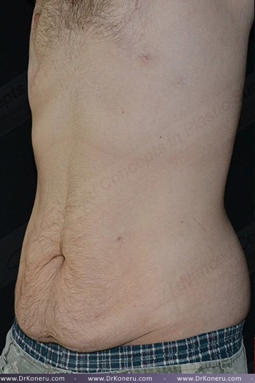 CoolSculpting Before & After Patient #1120