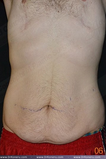 CoolSculpting Before & After Patient #1120