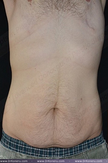 CoolSculpting Before & After Patient #1120