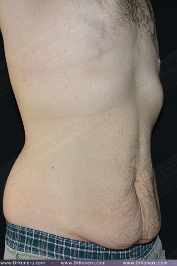 CoolSculpting Before & After Patient #1120