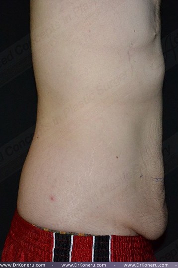 CoolSculpting Before & After Patient #1120