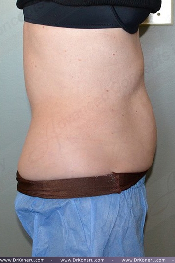 CoolSculpting Before & After Patient #1131