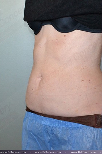 CoolSculpting Before & After Patient #1131