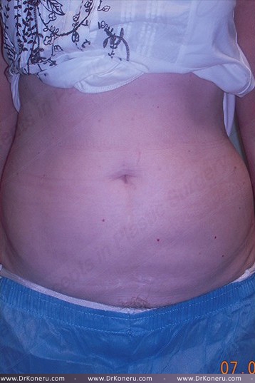 CoolSculpting Before & After Patient #1131