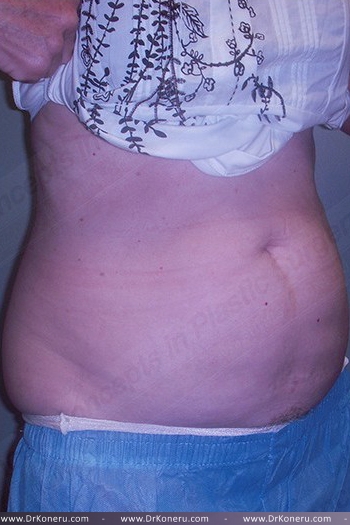 CoolSculpting Before & After Patient #1131