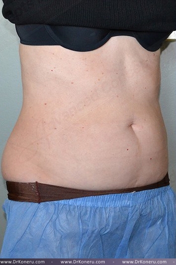 CoolSculpting Before & After Patient #1131