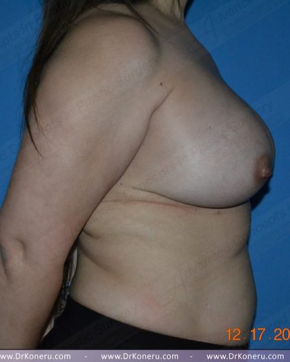 Breast Augmentation Before & After Patient #1164