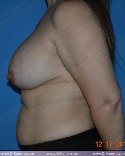 Breast Augmentation Before & After Patient #1164