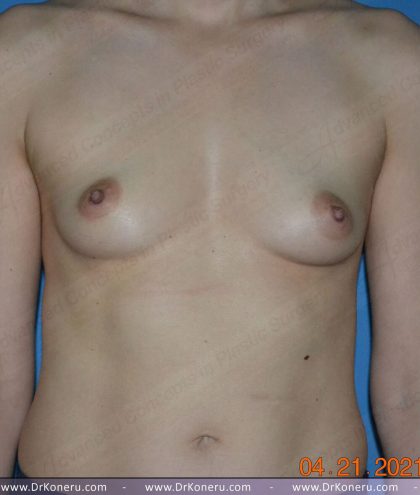 Breast Augmentation Before & After Patient #1312