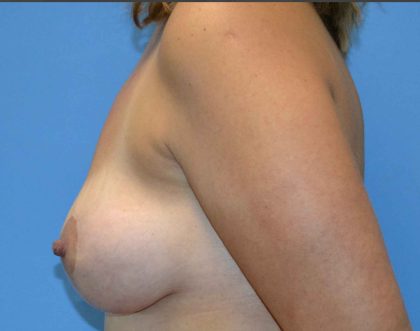 Breast Lift Before & After Patient #1336